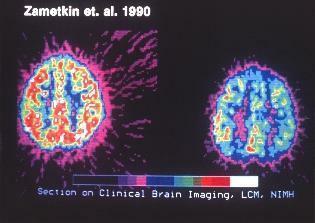 scansione di imaging clinico del cervello per adhd