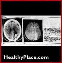 Il neurologo John Friedberg come i farmaci psichiatrici e l'elettroshock danneggiano il cervello. Dice che tutti soffrono di danni al cervello e perdita di memoria.