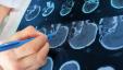 Le scansioni cerebrali 3D possono aumentare la precisione della diagnosi di ADHD