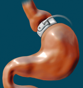 Lap-Band è un esempio di un tipo di chirurgia gastrica che può essere utilizzata per trattare il disturbo da alimentazione incontrollata.