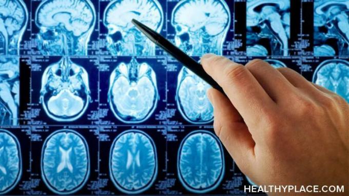 Le lesioni alla testa possono causare ansia. Quelli di noi con TBI sospettavano altrettanto, ma ora è stato dimostrato. Scopri le ultime ricerche su trauma cranico e ansia su HealthyPlace. Le commozioni cerebrali causano ansia ed ecco perché.